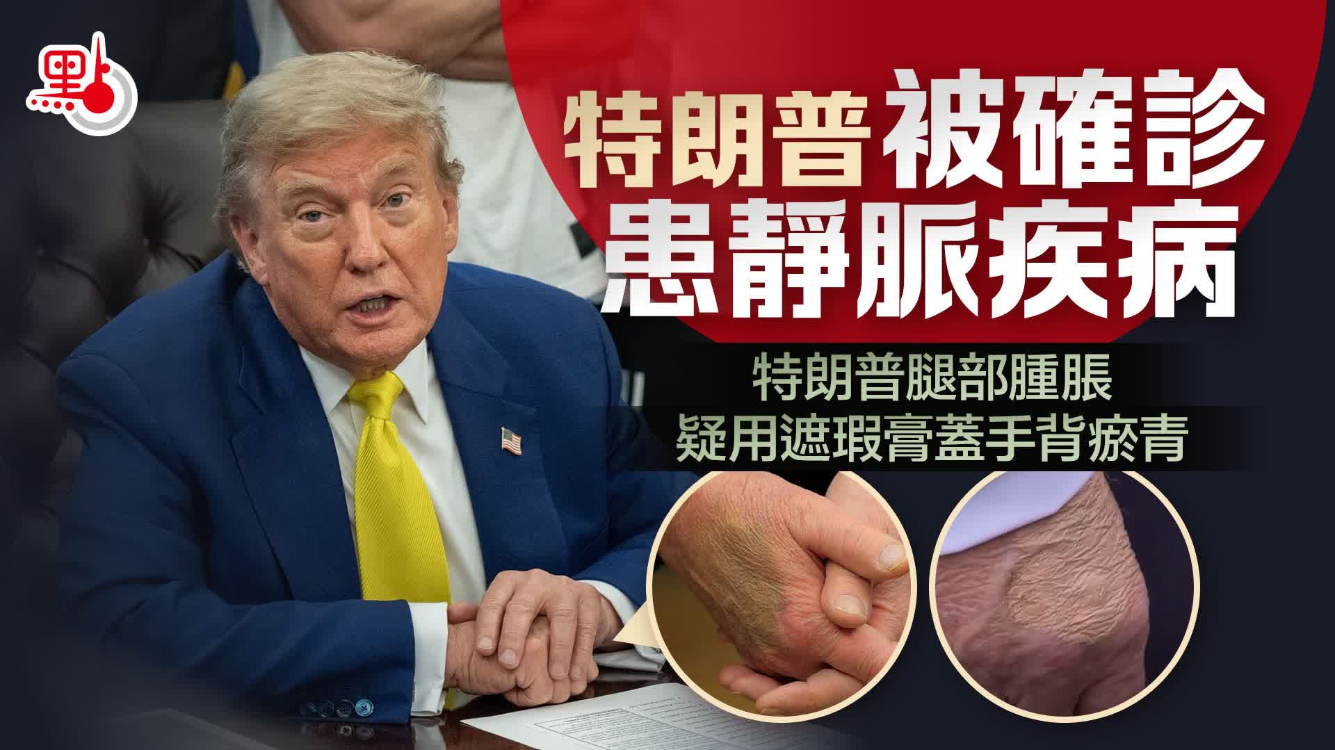（有片）特朗普被確診患靜脈疾病